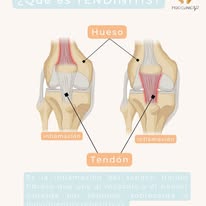 Tendinitis